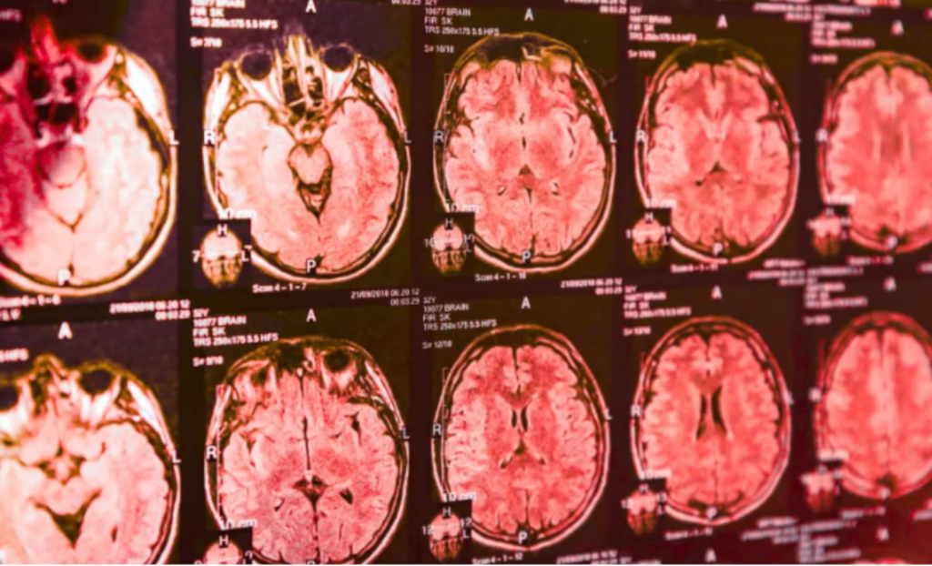 新的血液检测方法有望在出现震颤症状之前检测出帕金森病